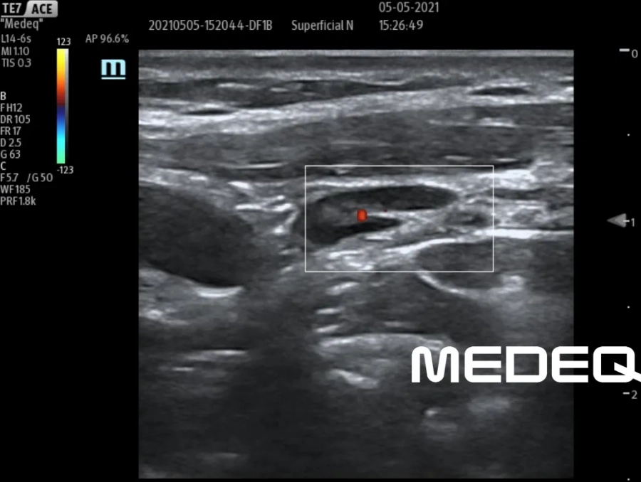 Фото Mindray L14-6s