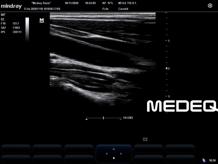 Фото Mindray 7L4s