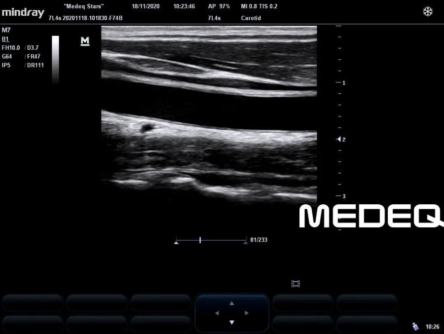 Фото Mindray 7L4s