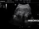 Фото Mindray 3C5s