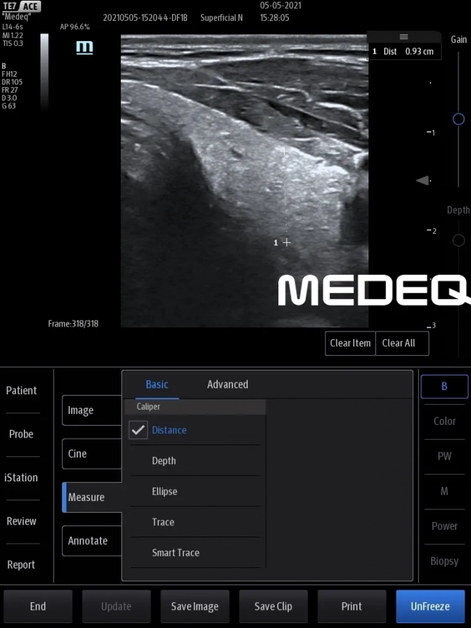 Фото Mindray L14-6s