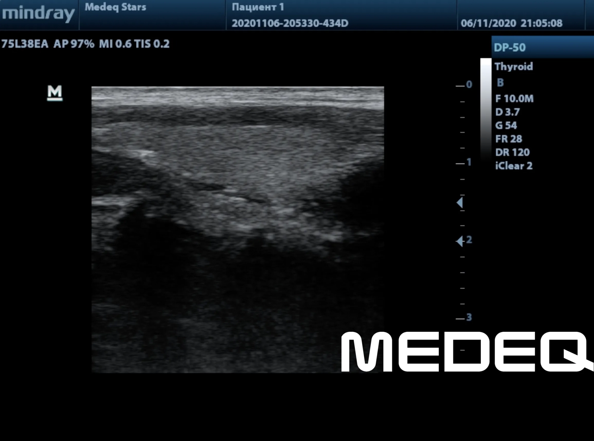 Фото Mindray 75L38EA